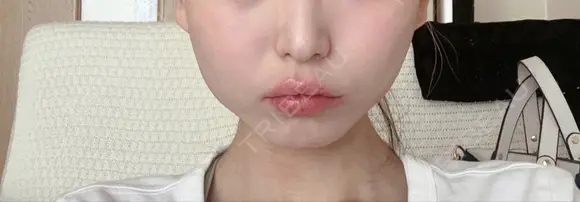 ボトックス（エラ・小顔） 湘南美容クリニック 岐阜院 AFTER メイン用