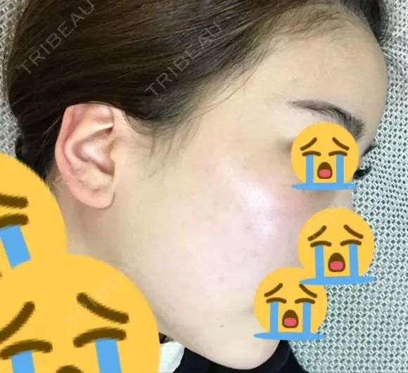 脂肪吸引（顔） / 額を丸く / 脂肪吸引（脚） / こめかみ形成 / 輪郭修正 / 脂肪注入（額） / 脂肪注入（輪郭） フレッシュ整形外科 DAY 17 メイン用