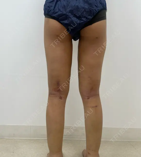 脂肪吸引（脚） / 脂肪吸引（お尻） 湘南美容クリニック 京都院 DAY 8 メイン用