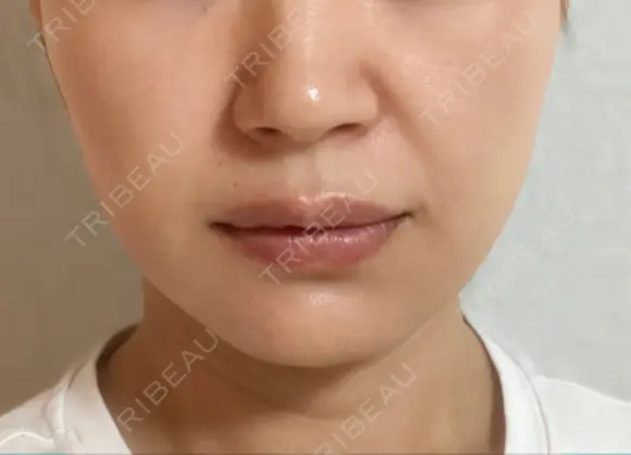 糸リフト / ヒアルロン酸注入（あご） ブルームクリニック（BLOOM CLINIC） AFTER メイン用