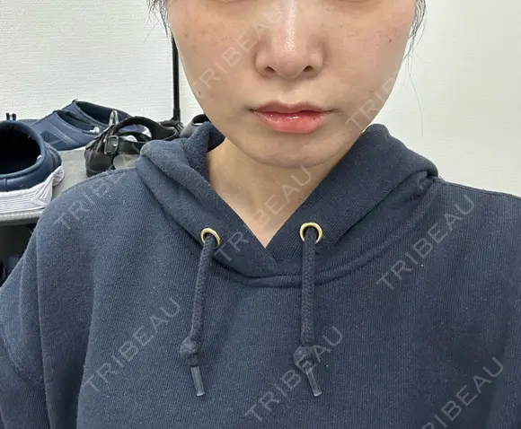 糸リフト / ヒアルロン酸注入（頬） EMMA CLINIC（エマクリニック） AFTER メイン用