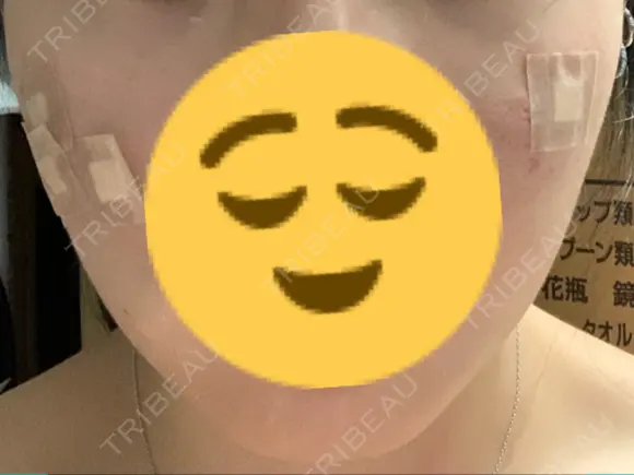 脂肪吸引（顔） 東京美専クリニック DAY 18 メイン用