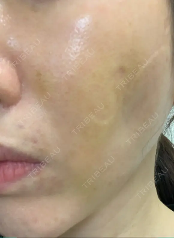 脂肪吸引注射（顔） イテウォンビューティークリニック 名古屋栄院 DAY 7 メイン用