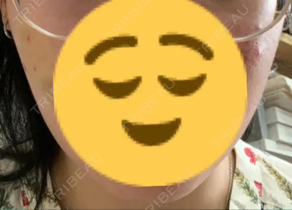 脂肪吸引（顔） 東京美専クリニック DAY 21 メイン用