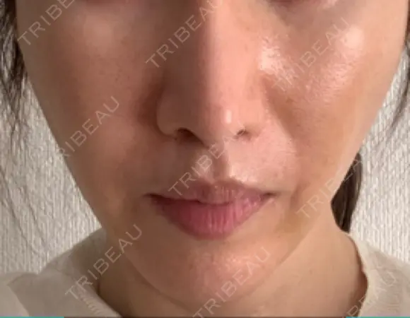 脂肪吸引注射（顔） イテウォンビューティークリニック 名古屋栄院 DAY 10 メイン用