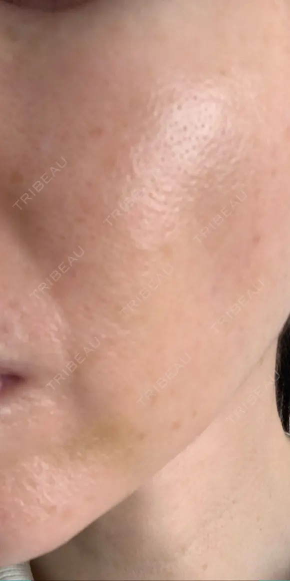 脂肪吸引注射（顔） イテウォンビューティークリニック 名古屋栄院 DAY 10 メイン用