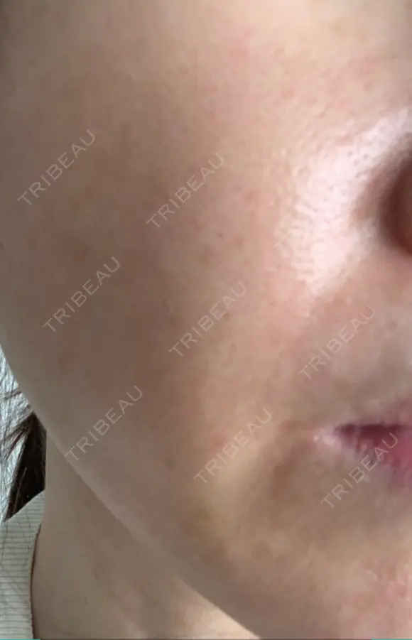 脂肪吸引注射（顔） イテウォンビューティークリニック 名古屋栄院 DAY 10 メイン用