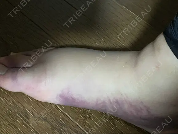 脂肪吸引（脚） / 脂肪吸引（お尻） 湘南美容クリニック 京都院 DAY 4 メイン用