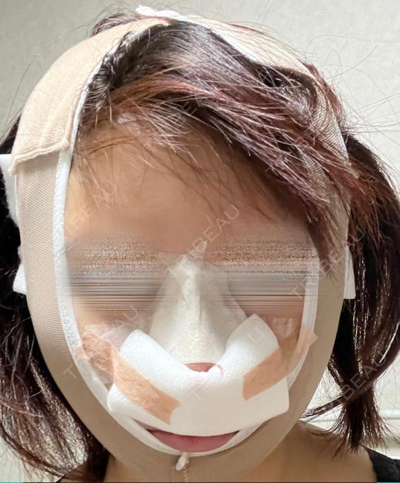 鼻尖形成（切開） / 糸リフト / 脂肪吸引（顔） / ジョールファット除去 / ヒアルロン酸注入（あご） / ヒアルロン酸注入（唇） / ボトックス（口角） / ヒアルロン酸注入（額） / ヒアルロン酸注入（鼻翼基部） 東京シンデレラ美容外科 池袋院 DAY 0 メイン用