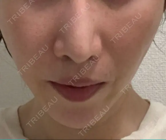 脂肪吸引注射（顔） イテウォンビューティークリニック 名古屋栄院 DAY 11 メイン用