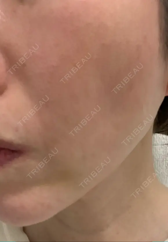 脂肪吸引注射（顔） イテウォンビューティークリニック 名古屋栄院 DAY 11 メイン用