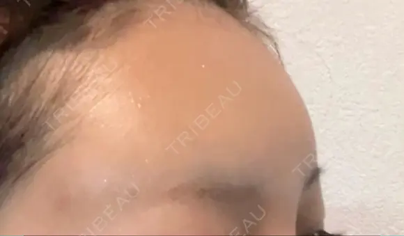 ヒアルロン酸注入（額） LA CLEF CLINIC（ラクレクリニック） DAY 1 メイン用