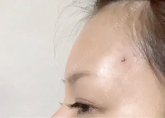 ヒアルロン酸注入（額） LA CLEF CLINIC（ラクレクリニック） DAY 1 メイン用