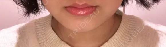 脂肪溶解注射（まぶた） 横浜中央クリニック 横浜院 DAY 1 メイン用