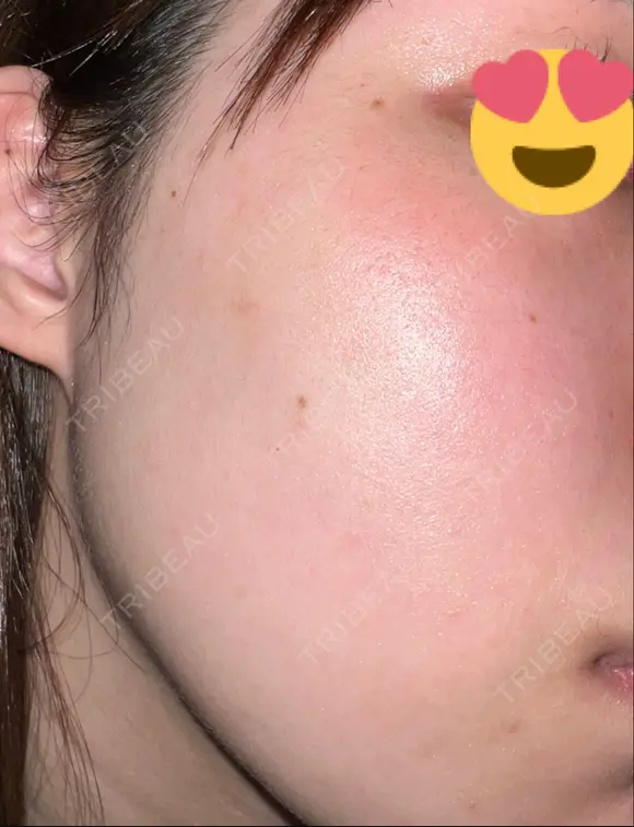 ピーリング（ニキビ・毛穴） LIFIX BEAUTY CLINIC AFTER メイン用