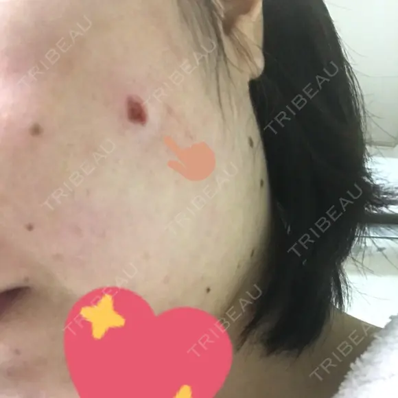 ほくろ・いぼ切除（肌） 甲府昭和形成外科クリニック DAY 1 メイン用