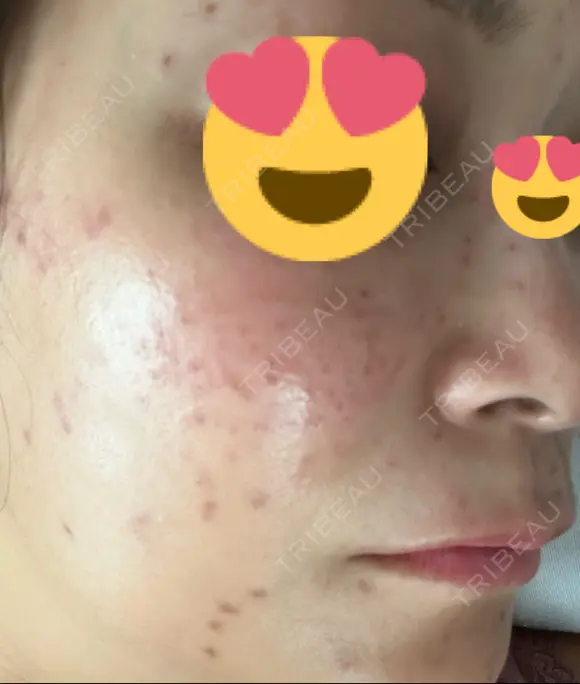 シミ取りレーザー Mavie Beauty Clinic （マヴィービューティークリニック） DAY 2 メイン用