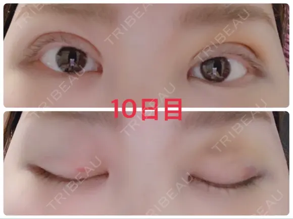 二重埋没 / 上まぶたの脂肪取り 湘南美容クリニック 奈良院 AFTER メイン用