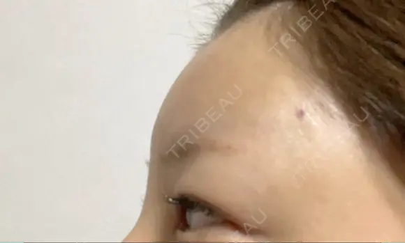 ヒアルロン酸注入（額） LA CLEF CLINIC（ラクレクリニック） DAY 3 メイン用