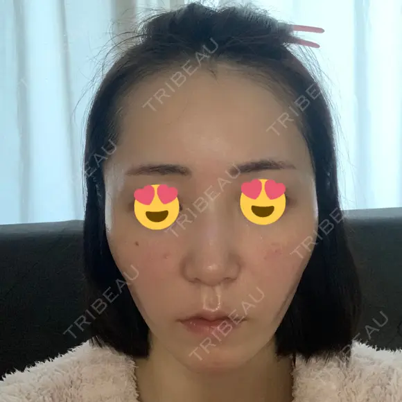 ハイフ（顔） 心斎橋形成外科スキンケアクリニック AFTER メイン用