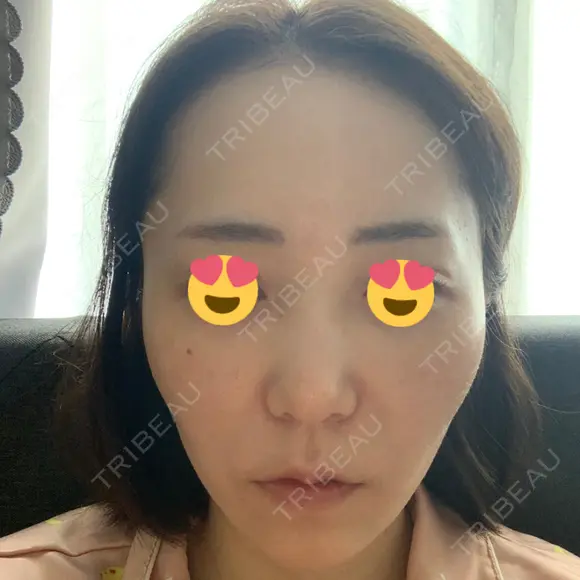 ハイフ（顔） 心斎橋形成外科スキンケアクリニック DAY 0 メイン用