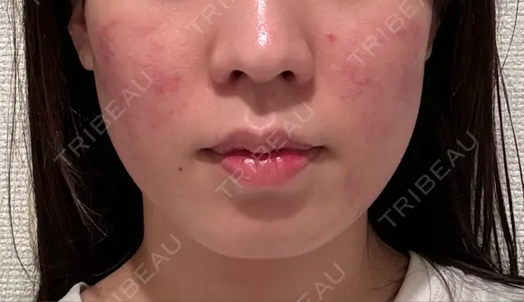 医療痩身（顔） リアルクリニック（REAL CLINIC） DAY 0 メイン用