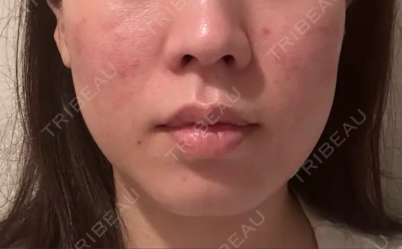 医療痩身（顔） リアルクリニック（REAL CLINIC） DAY 1 メイン用