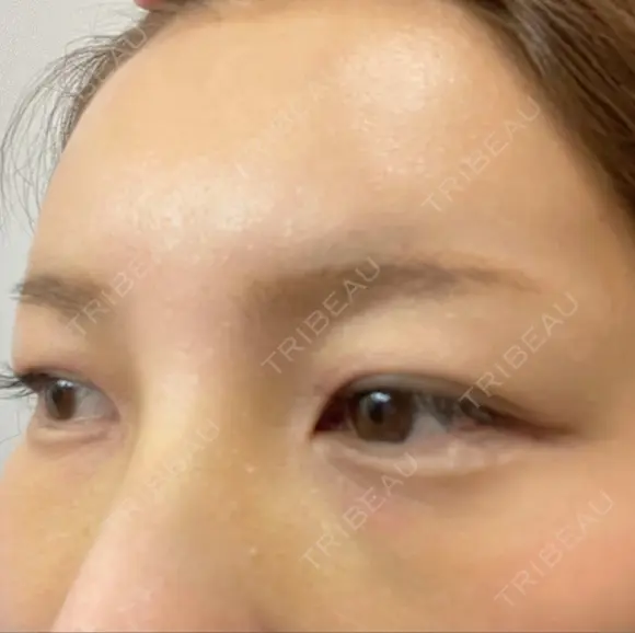 ヒアルロン酸注入（額） LA CLEF CLINIC（ラクレクリニック） DAY 6 メイン用