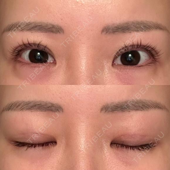 二重埋没 品川スキンクリニック 宇都宮院（※品川美容外科提携） DAY 18 メイン用