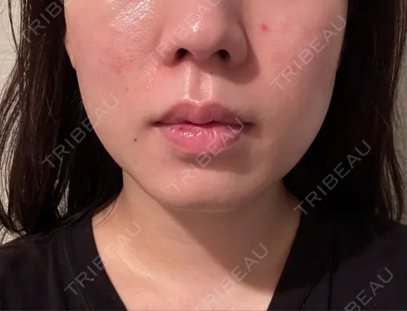 医療痩身（顔） リアルクリニック（REAL CLINIC） DAY 3 メイン用