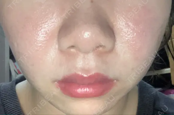 ヒアルロン酸注入（涙袋） 渋谷美容外科クリニック 横浜院 AFTER メイン用