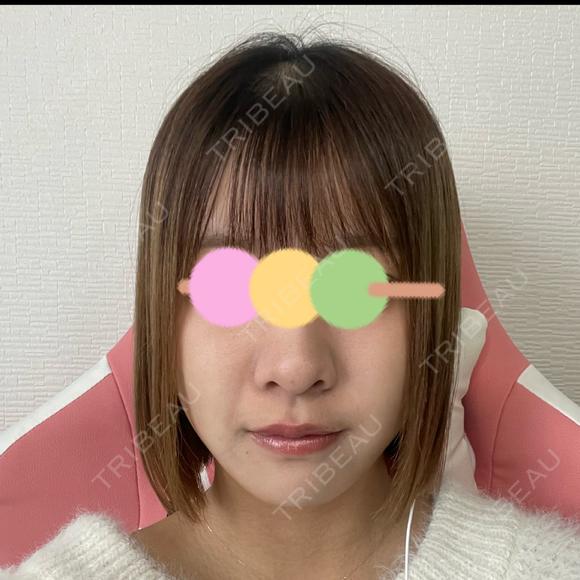 糸リフト / ヒアルロン酸注入（あご） / ボトックス（エラ・小顔） / 脂肪溶解注射（顔） 大阪TAクリニック DAY 9 メイン用