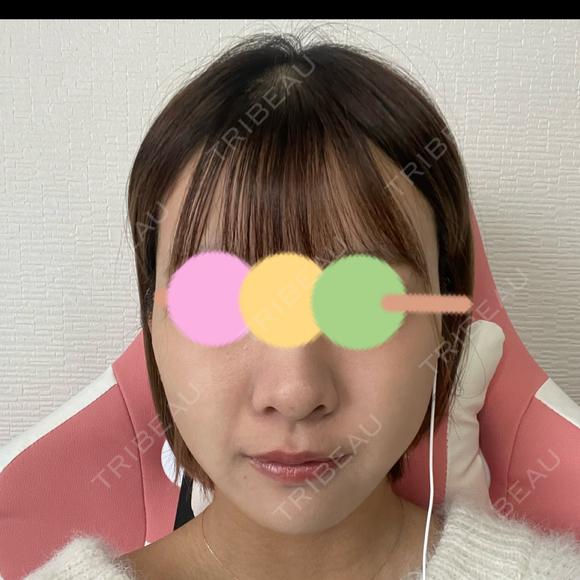 糸リフト / ヒアルロン酸注入（あご） / ボトックス（エラ・小顔） / 脂肪溶解注射（顔） 大阪TAクリニック DAY 9 メイン用
