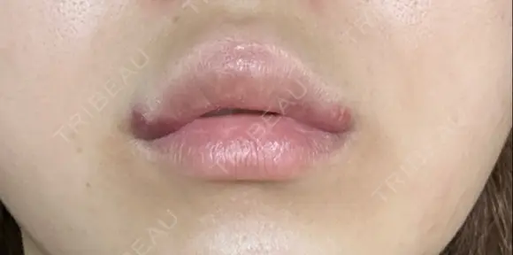 ヒアルロン酸注入（唇） / ボトックス（口角） ブルームクリニック（BLOOM CLINIC） DAY 1 メイン用