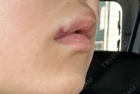 ヒアルロン酸注入（唇） / ボトックス（口角） ブルームクリニック（BLOOM CLINIC） DAY 1 メイン用