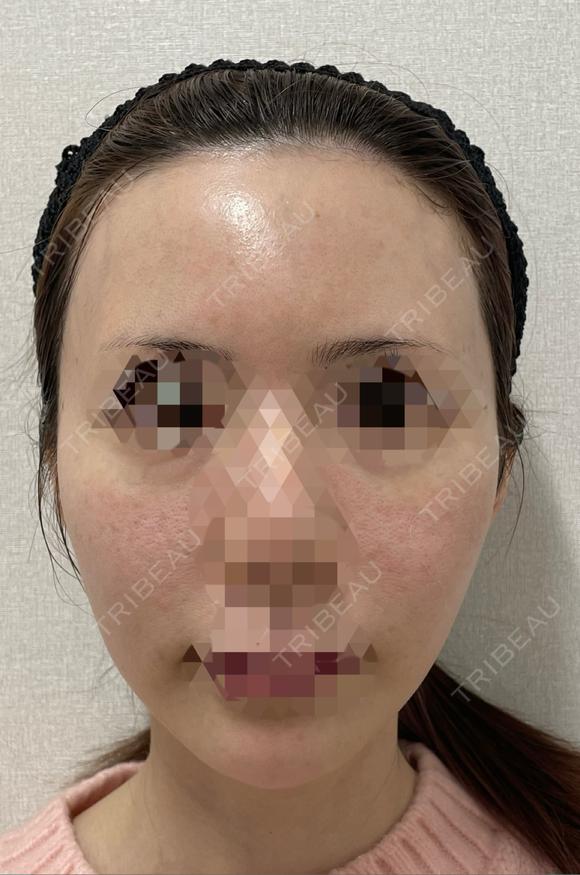 水光注射（ハリ・美肌） フィラークリニック 錦糸町院 AFTER メイン用
