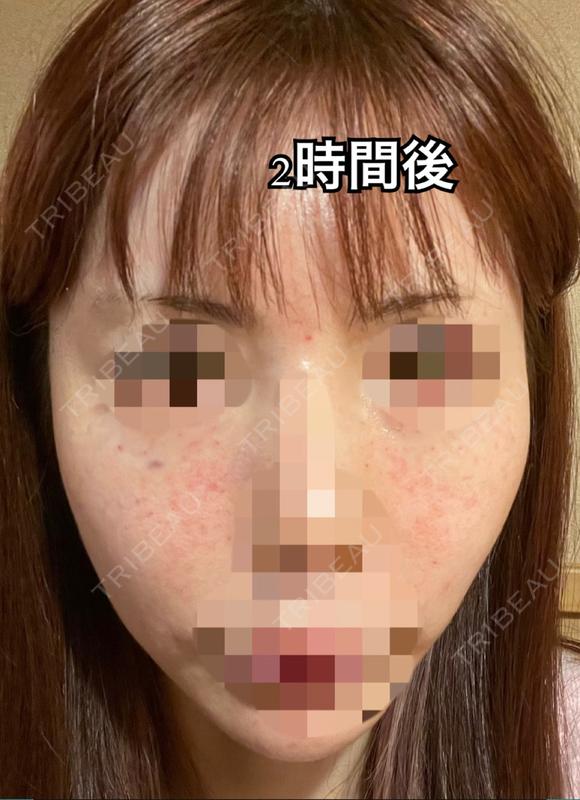 水光注射（ハリ・美肌） フィラークリニック 錦糸町院 DAY 0 メイン用