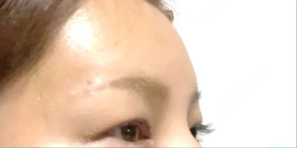 ヒアルロン酸注入（額） LA CLEF CLINIC（ラクレクリニック） AFTER メイン用