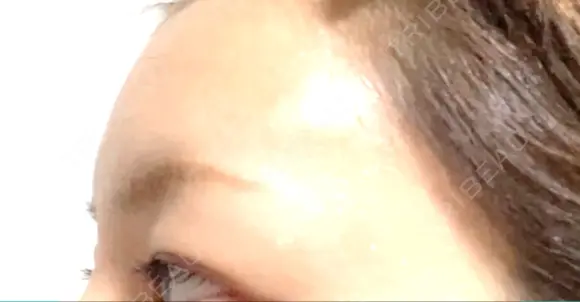 ヒアルロン酸注入（額） LA CLEF CLINIC（ラクレクリニック） DAY 10 メイン用