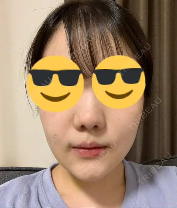 脂肪吸引注射（顔） イテウォンビューティークリニック 名古屋栄院 DAY 7 メイン用