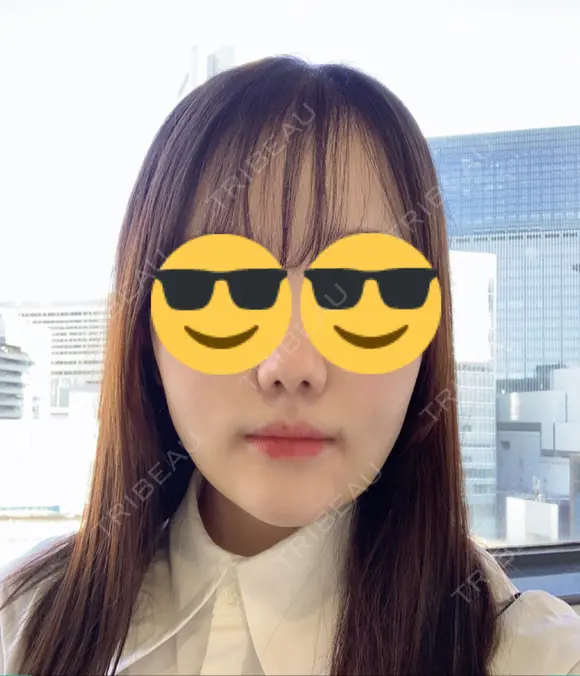 脂肪吸引注射（顔） イテウォンビューティークリニック 名古屋栄院 DAY 10 メイン用