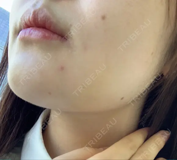 脂肪吸引注射（顔） イテウォンビューティークリニック 名古屋栄院 DAY 10 メイン用