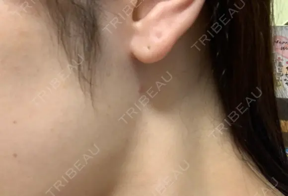 脂肪吸引注射（顔） イテウォンビューティークリニック 名古屋栄院 DAY 24 メイン用