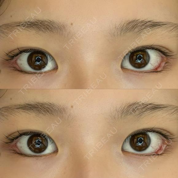 目尻切開 / タレ目形成・グラマラスライン（埋没） / 美容点滴・美容注射（美肌） LOUIS CLINIC 二子玉川院【ルイクリニック】 DAY 1 メイン用