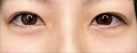 クマ治療 / 下まぶたたるみ取り / 下まぶたの脂肪取り 品川美容外科 渋谷院（※品川スキンクリニック提携） AFTER メイン用