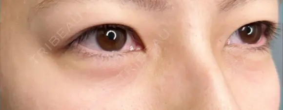 クマ治療 / 下まぶたたるみ取り / 下まぶたの脂肪取り 品川美容外科 渋谷院（※品川スキンクリニック提携） DAY 0 メイン用