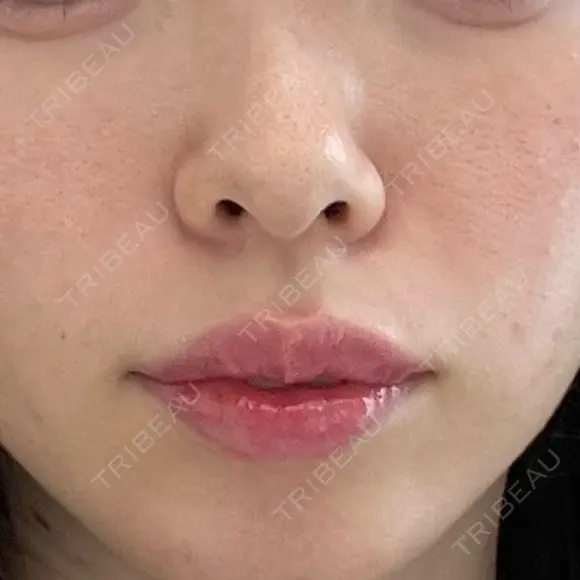 ヒアルロン酸注入（鼻翼基部） ルラ美容クリニック 渋谷本院 DAY 0 メイン用