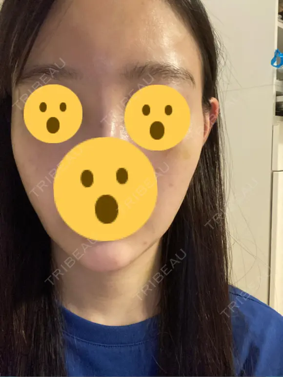 ハイフ（顔） リエンジャン整形外科 明洞店 DAY 3 メイン用