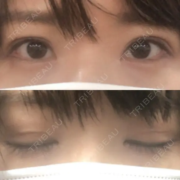 二重切開 / 目元修正 ルネッサンス美容外科医院 神戸院 DAY 66 メイン用