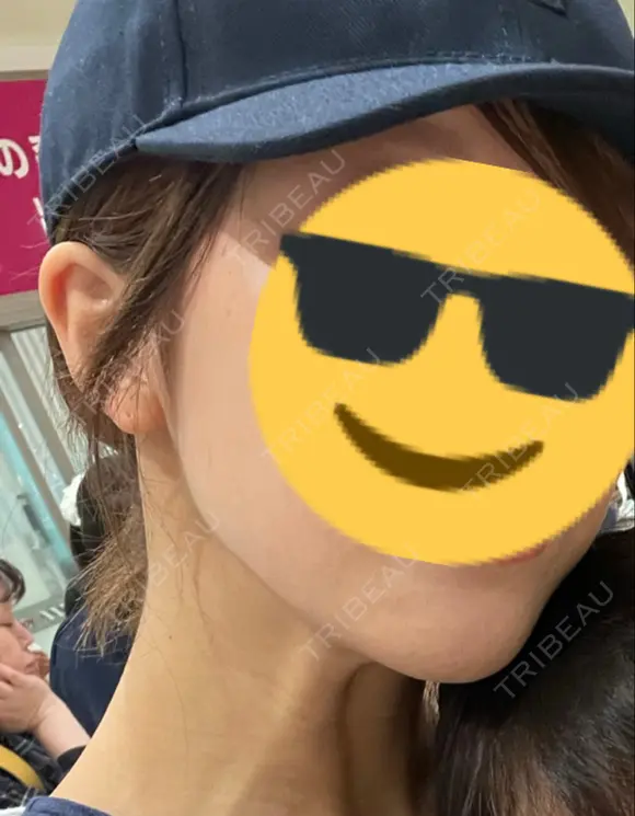 ハイフ（顔） / ハイフ（首） TCB東京中央美容外科 熊本院 AFTER メイン用